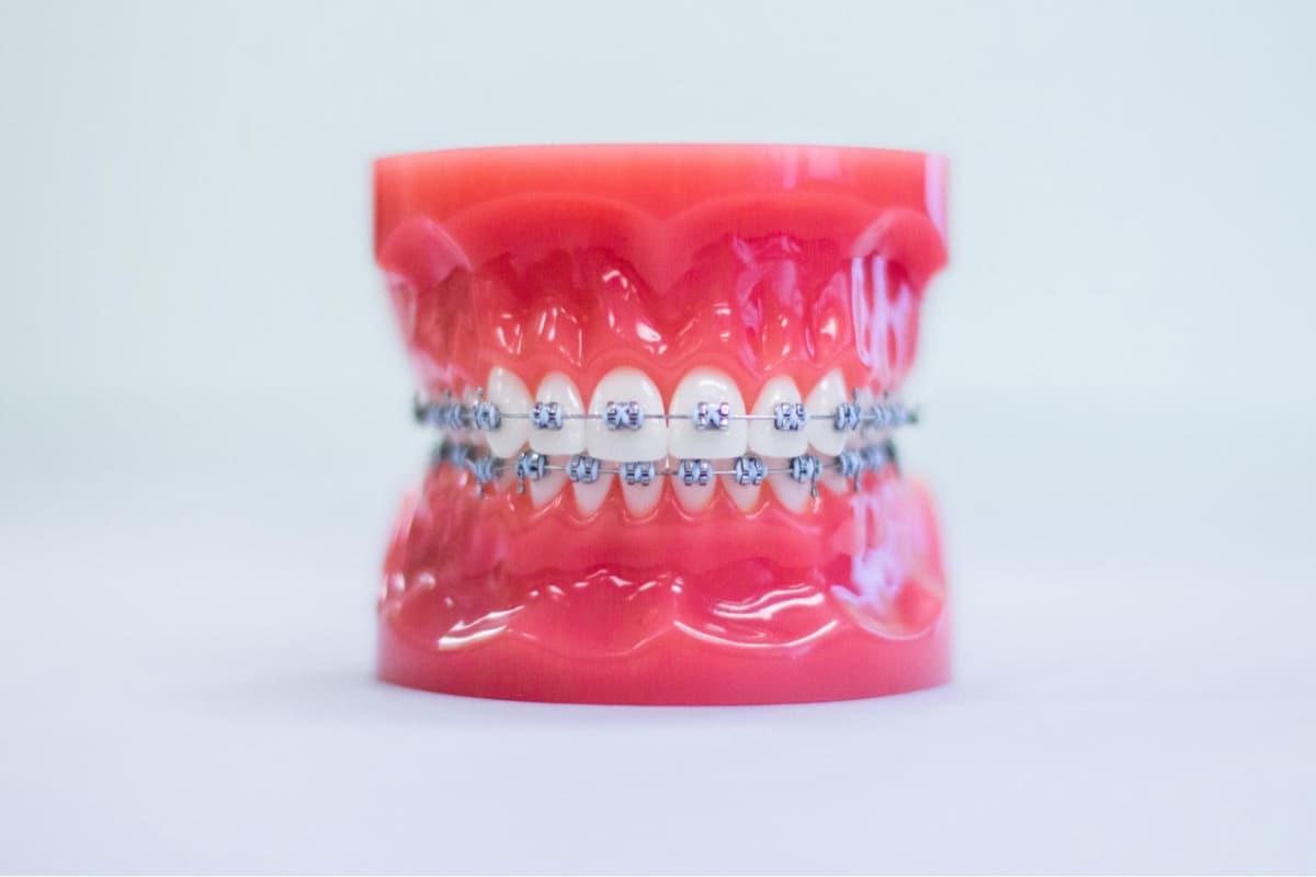 Metal Braces Treatment