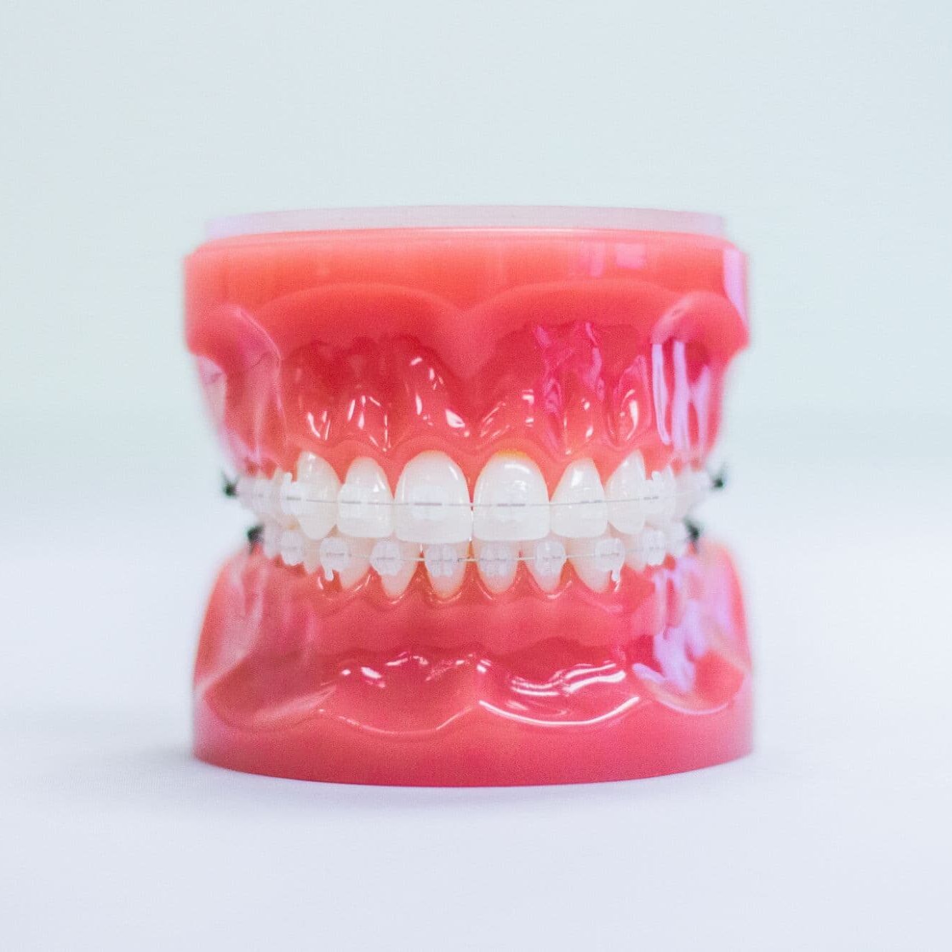 Model of teeth with clear braces demonstrating orthodontic treatment options at Foley Orthodontics, highlighting clear aligners and modern metal braces for patients in Cary, NC.